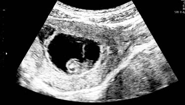 3D/4D Sonography